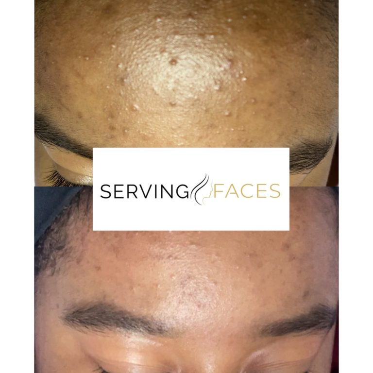 Teen Skin Care Facial for Teens Teen Facial Treatment